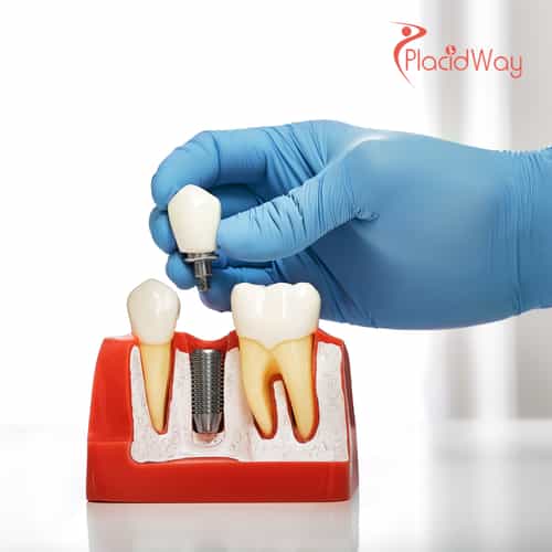 A Growing Trend: Russian Patients Choose Georgia for World-Class Dental Implant Procedures